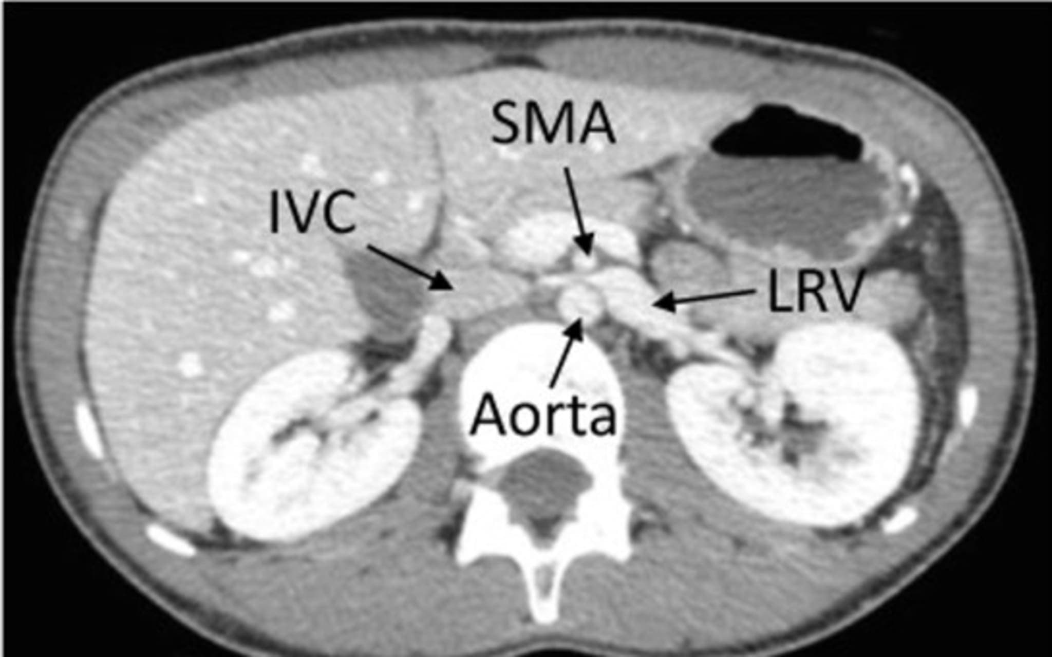 CT-Aufnahme des Patienten mit Nussknacker-Syndrom, die Vena renalis sinistra ist zwischen Aorta und Arteria mesenterica superrior eingeklemmt.