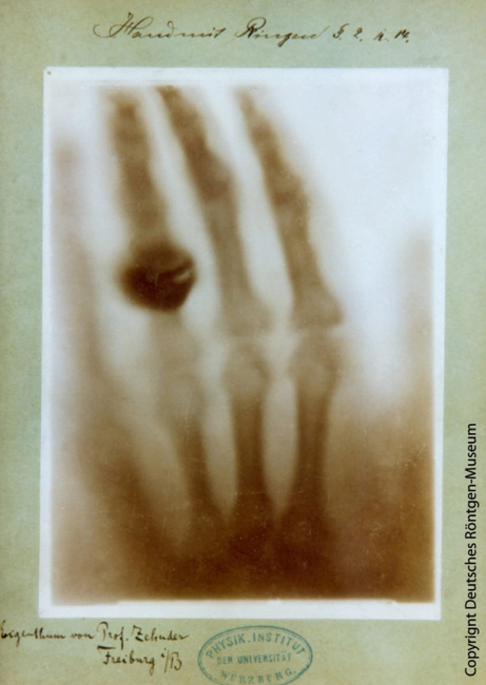 Erstes Röntgenbild eines lebenden Menschen, Bertha Röntgens Hand, 1895