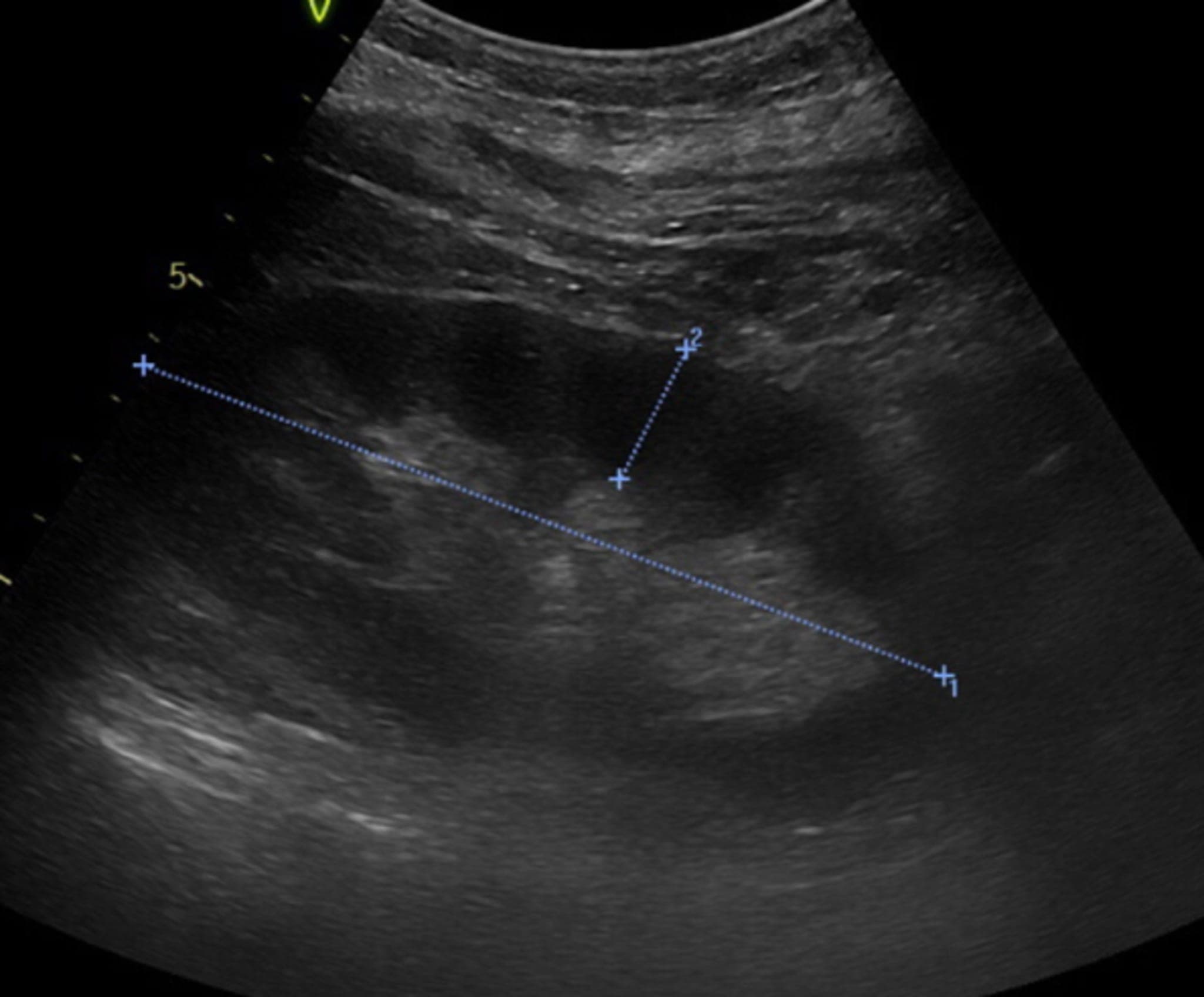 Ungeklärte akute Nierenfunktionseinschränkung