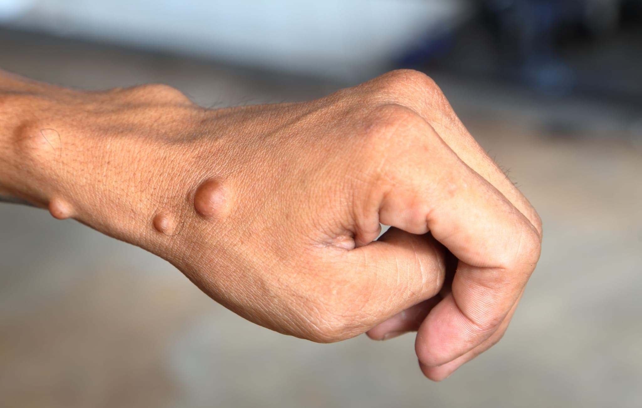 Neurofibrome an der Hand