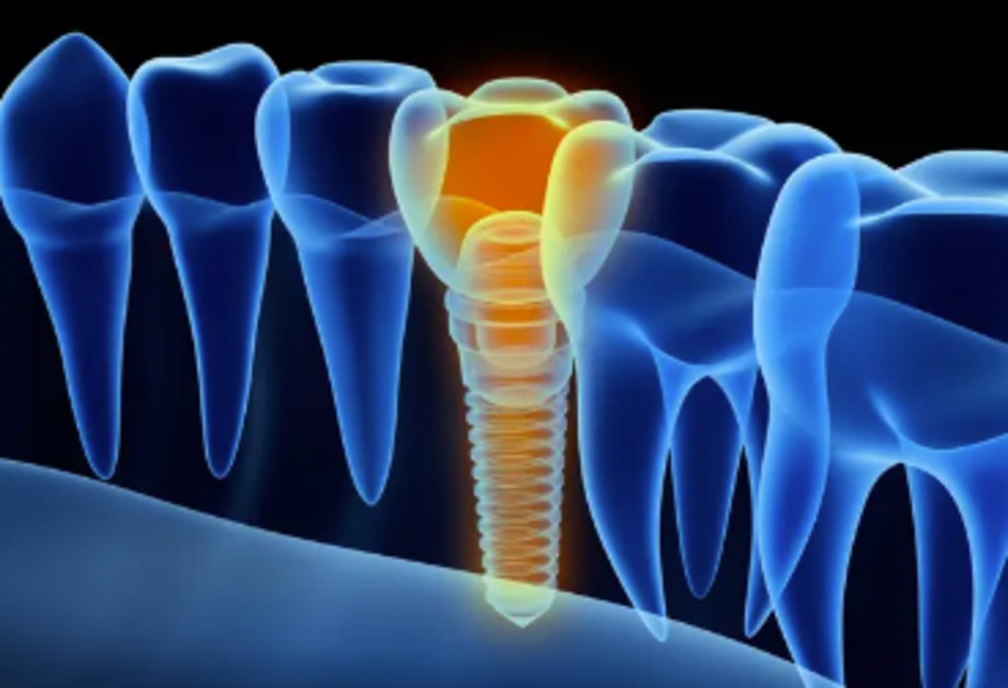 Leitlinie Keramikimplantate