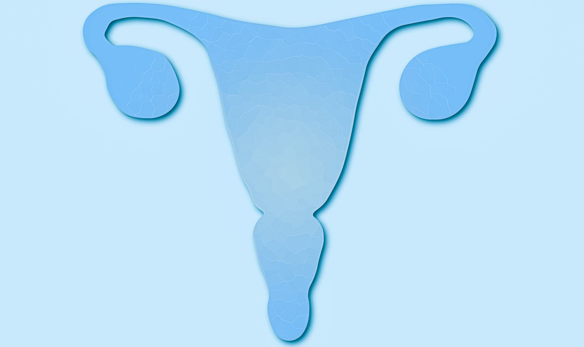 S2k-Leitlinie „Uterine Sarkome“ aktualisiert