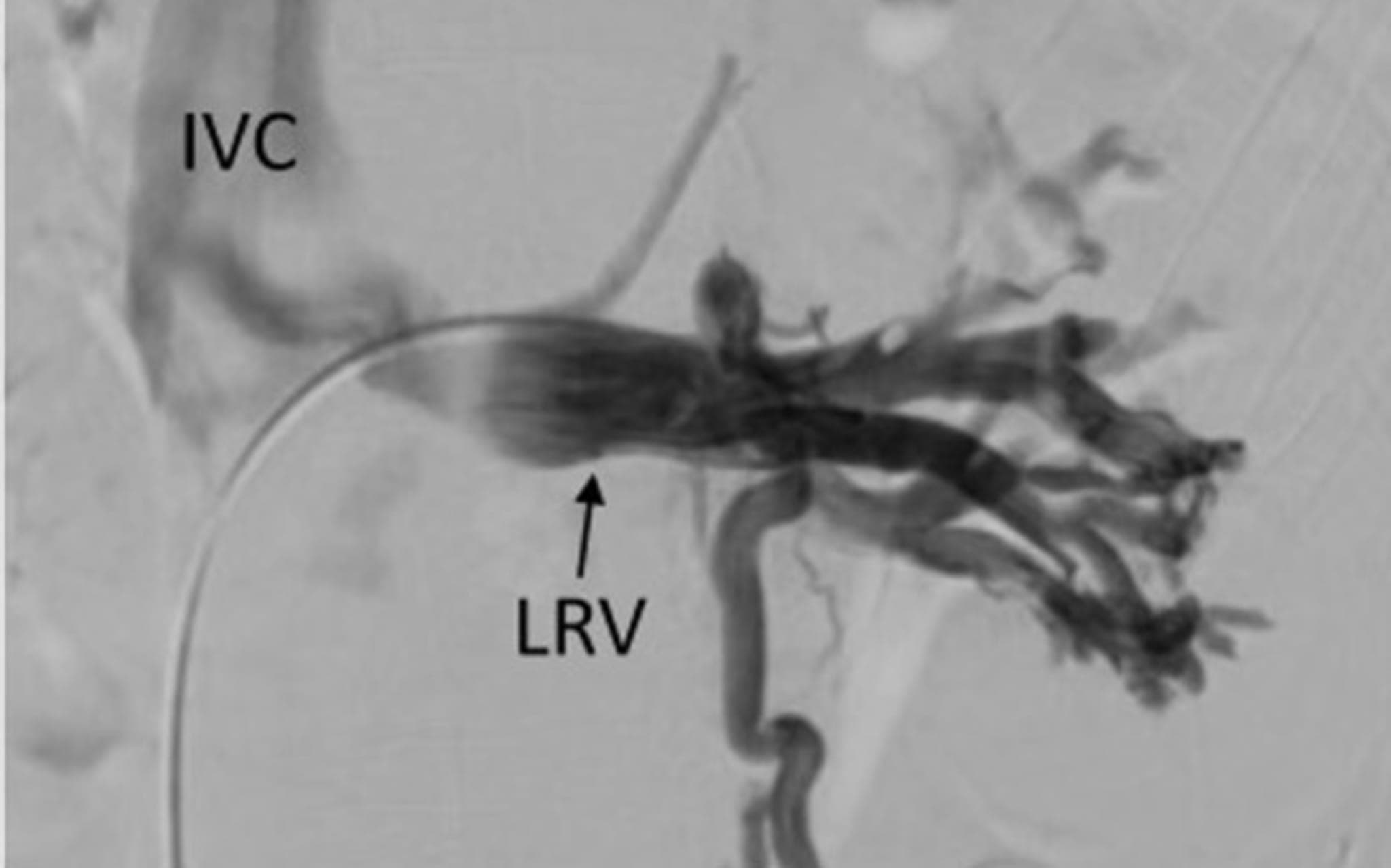 Angiografische Aufnahme der Vena renalis sinistra und umgebender Gefäße
