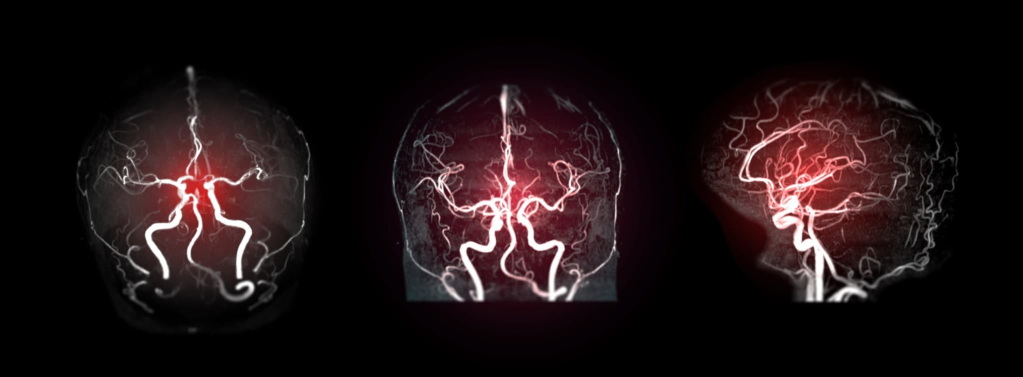 S2k-Leitlinie Zerebrale Sinus- und Venenthrombose