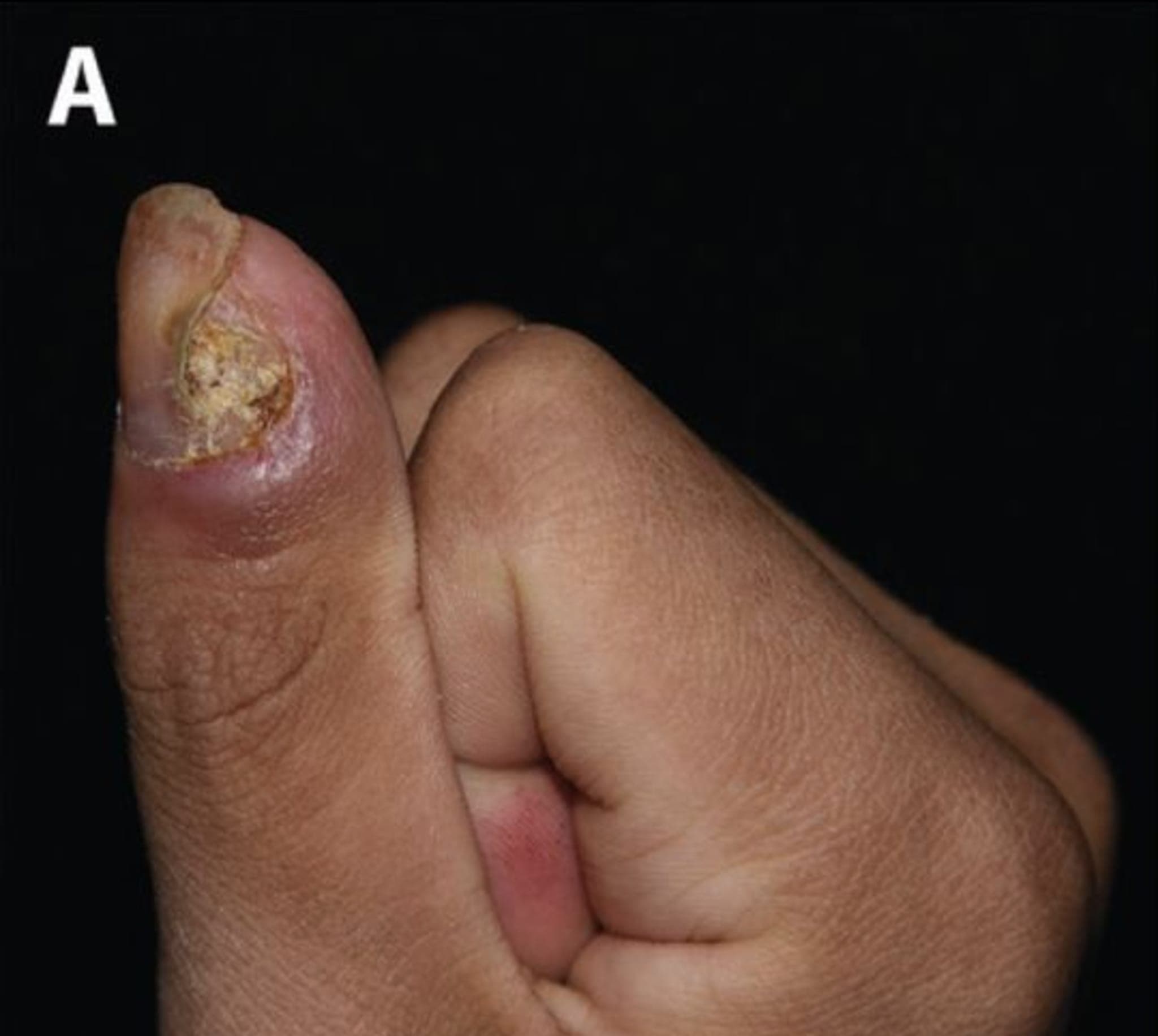 Nagelablösung am Daumen