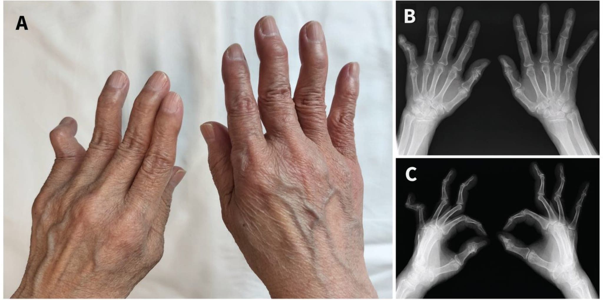 Deformierte Finger, daneben Röntgenaufnahmen der Hände