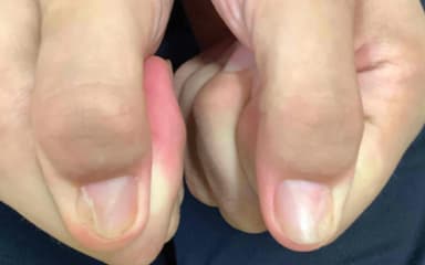 Titelbild von Bild der Woche: Deformierte Fingernägel