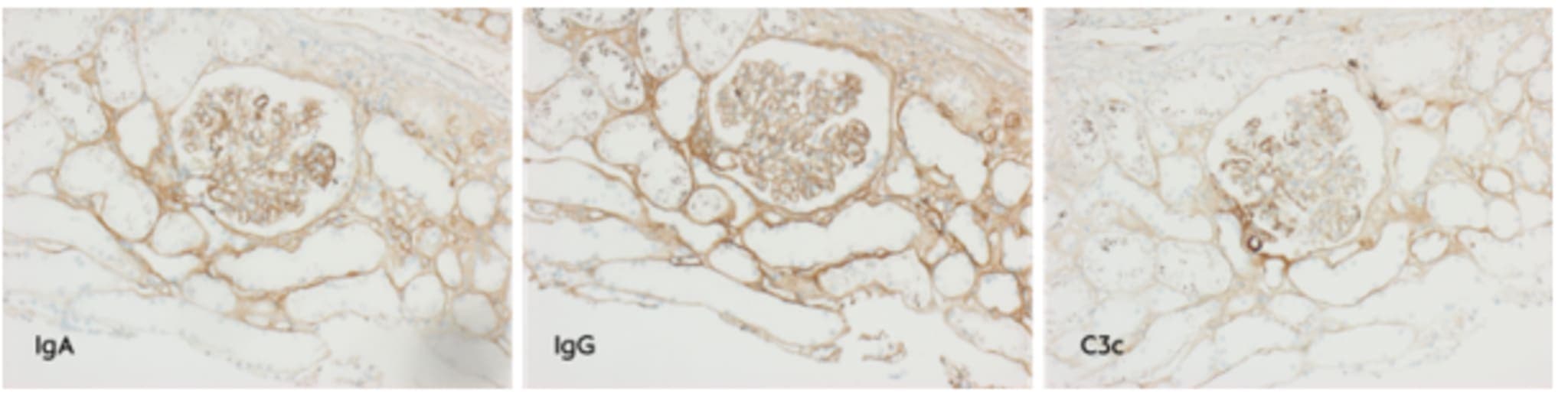 Ungeklärte akute Nierenfunktionseinschränkung und Infekt ohne Erreger