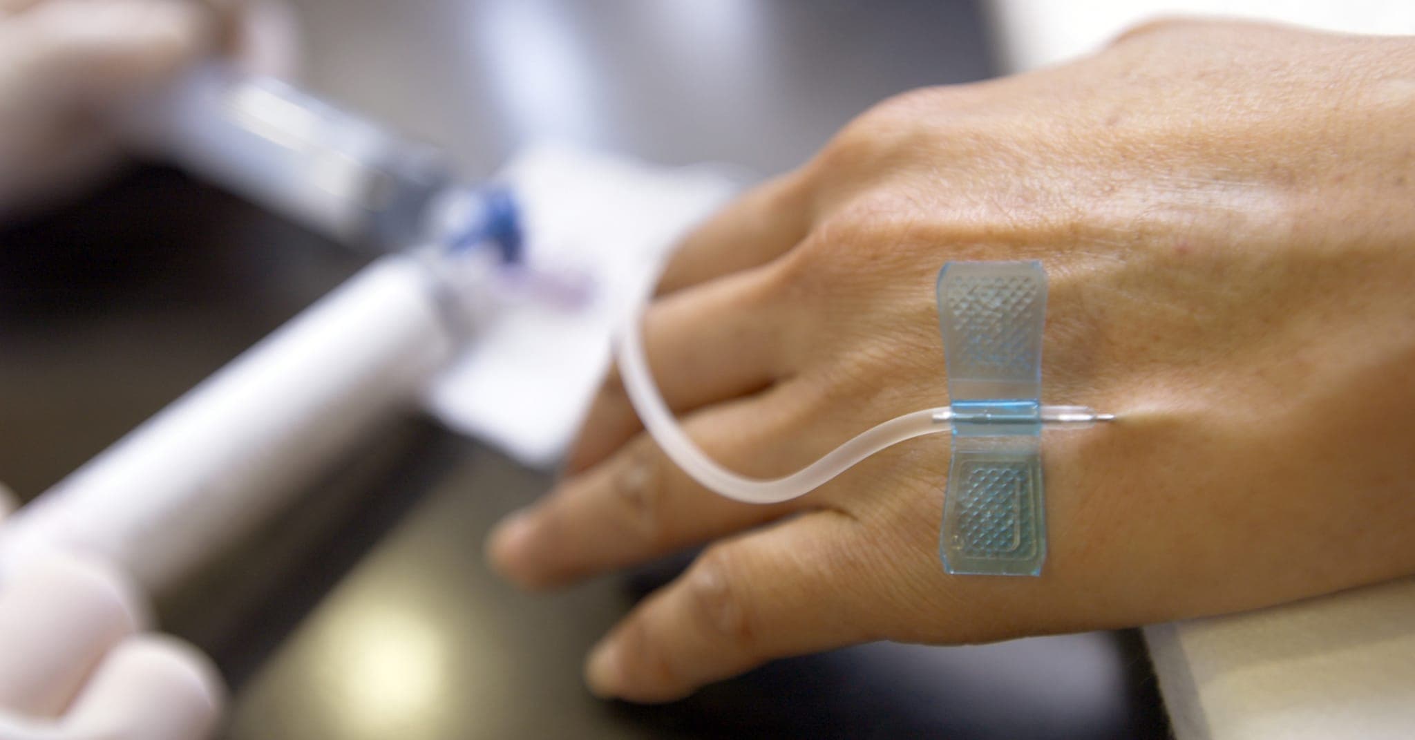 Akupunktur gegen Übelkeit und Erbrechen unter Chemotherapie