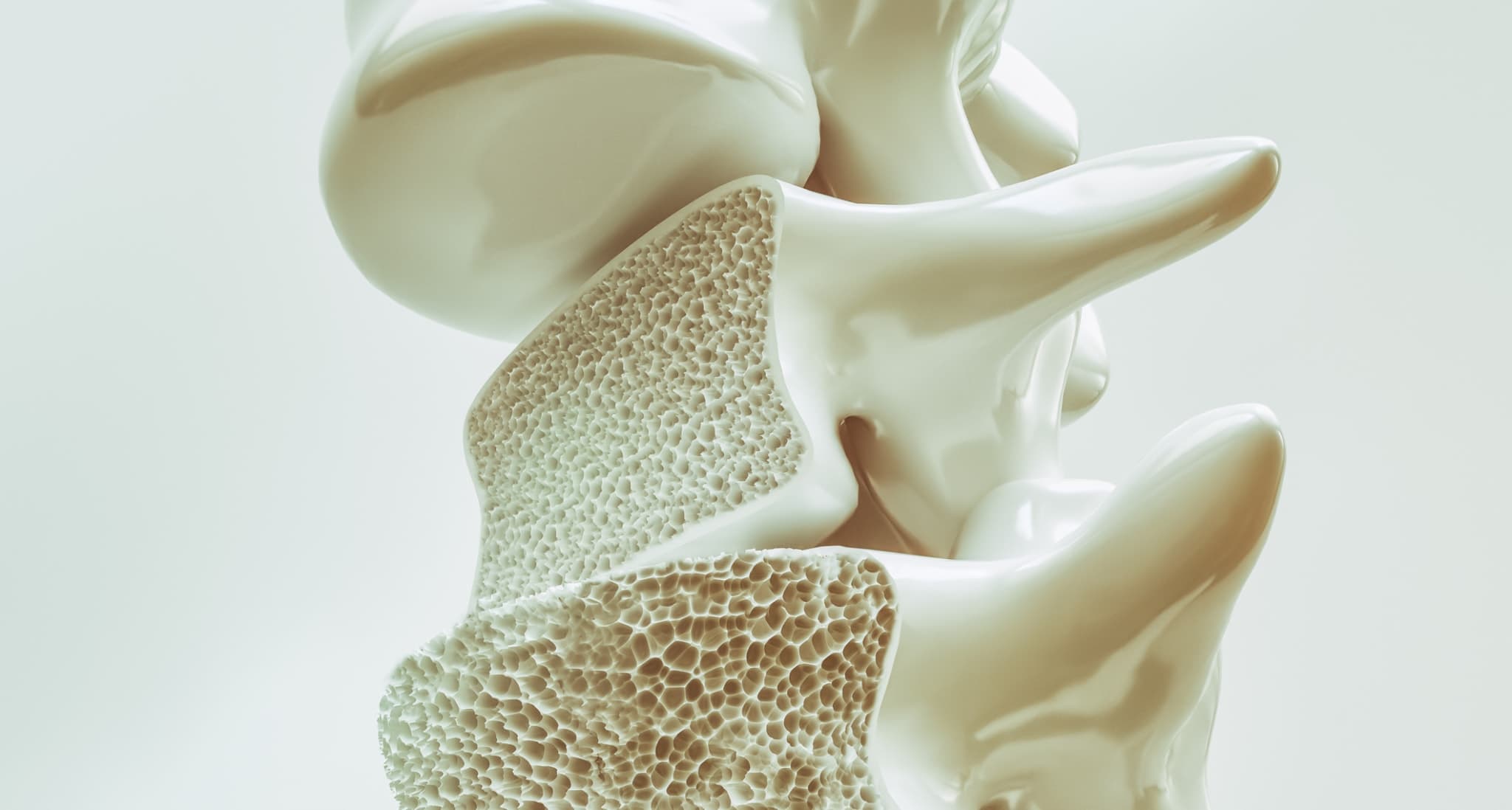 Die 5 wichtigsten Osteoporose-Risikofaktoren