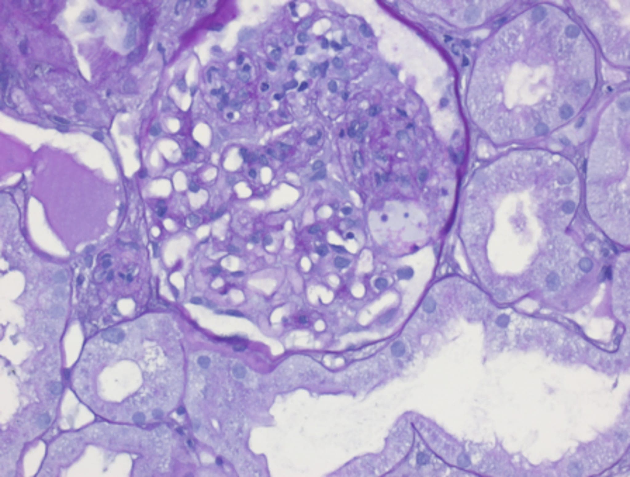 Ungeklärte akute Nierenfunktionseinschränkung und Infekt ohne Erreger