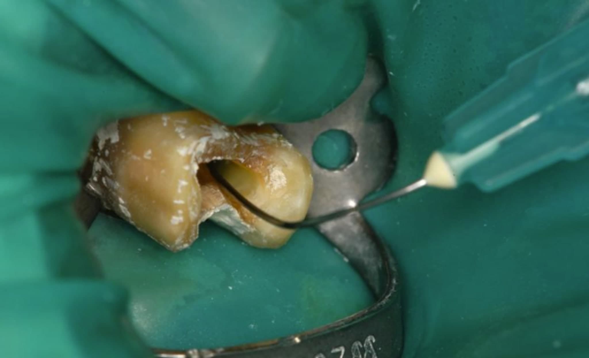 Endodontie kann Herzerkrankungsrisiko senken