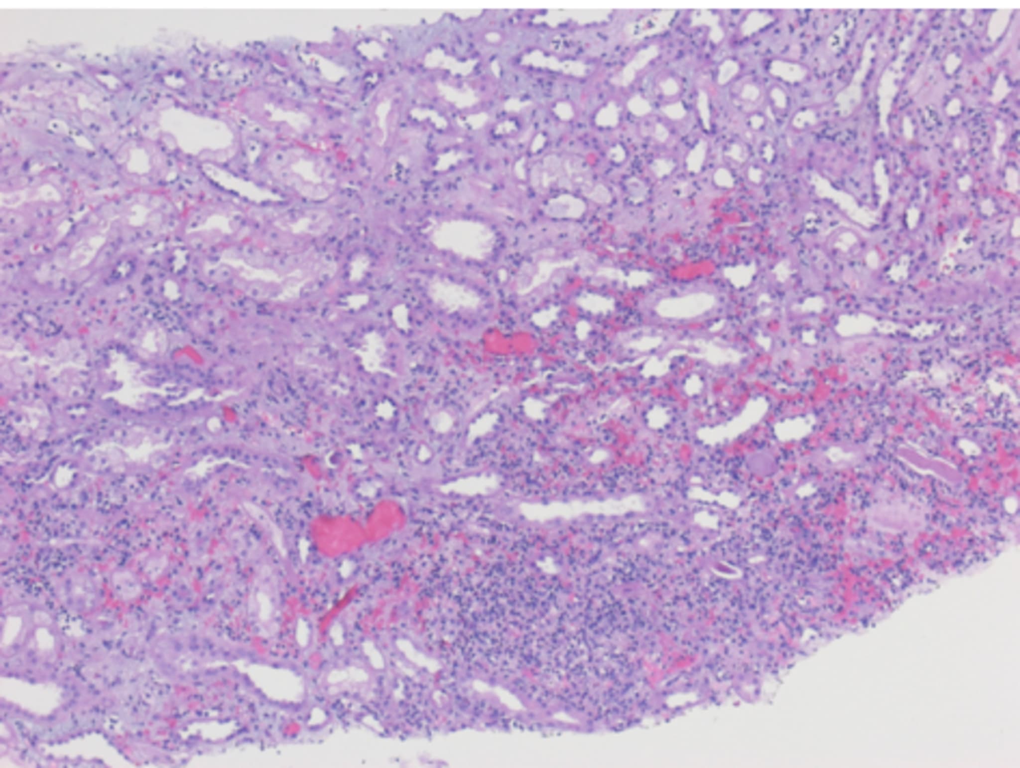 Ungeklärte akute Nierenfunktionseinschränkung und Infekt ohne Erreger