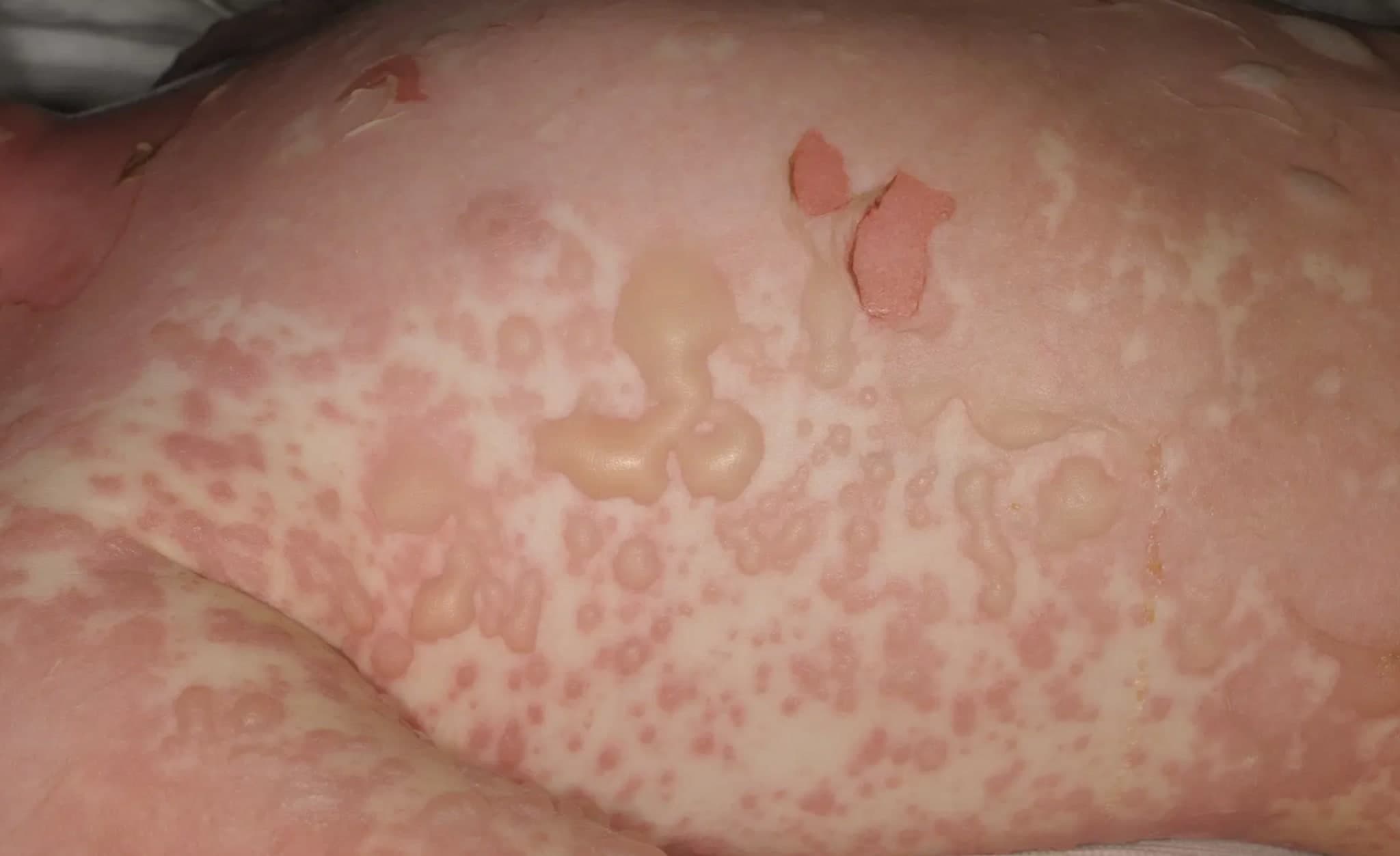 Toxische epidermale Nekrolyse: Bahnbrechende Erfolge mit JAK-Inhibitoren