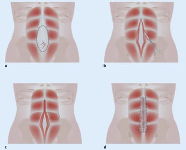 Narbenhernien Minimalinvasive Operationsverfahren narbenhernien-minimalinvasive-operationsverfahren