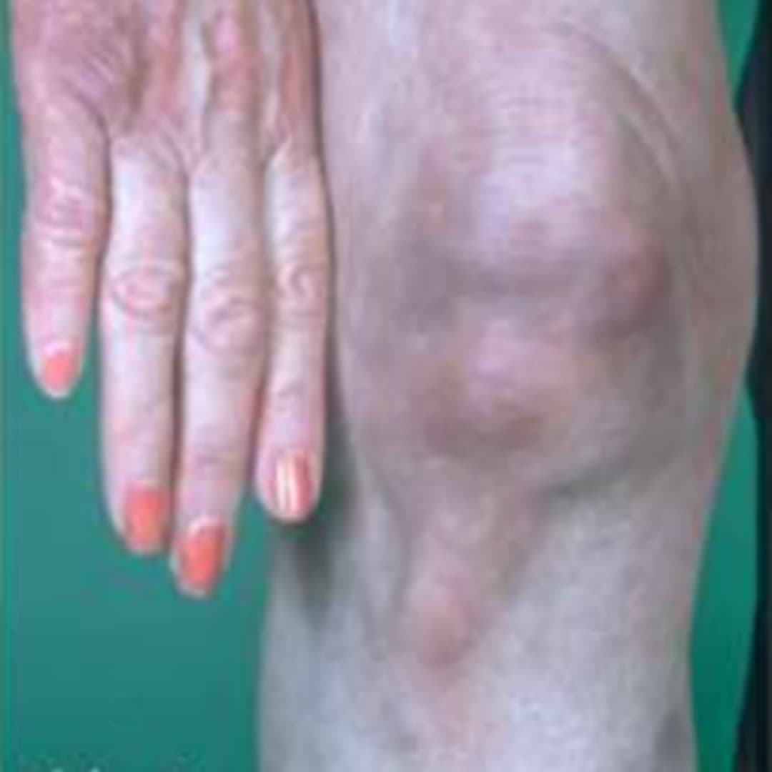 Lyme Borreliose Richtig Behandeln lyme-borreliose-richtig-behandeln